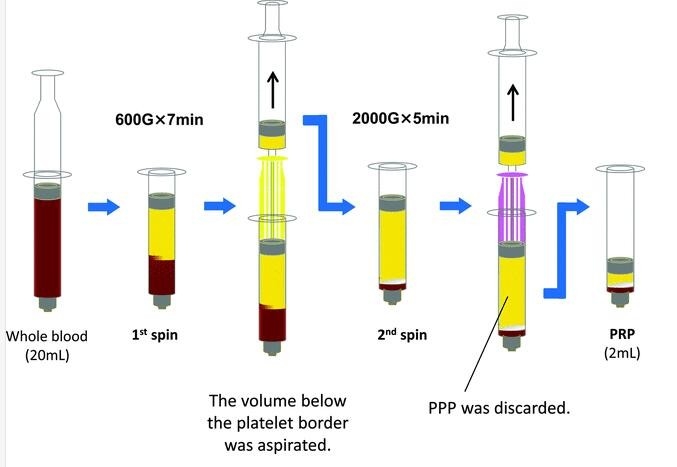 Kit PRP for PRP centrifuges platelet rich plasma  disposable syringe Brushless motor